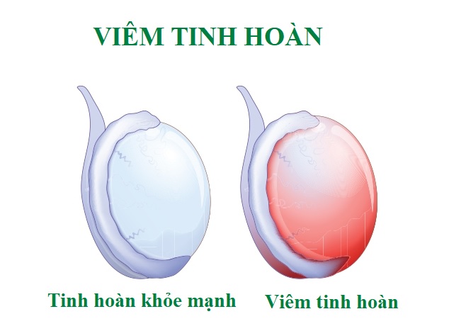 Viêm Tinh Hoàn Có Nguy Hiểm Không
